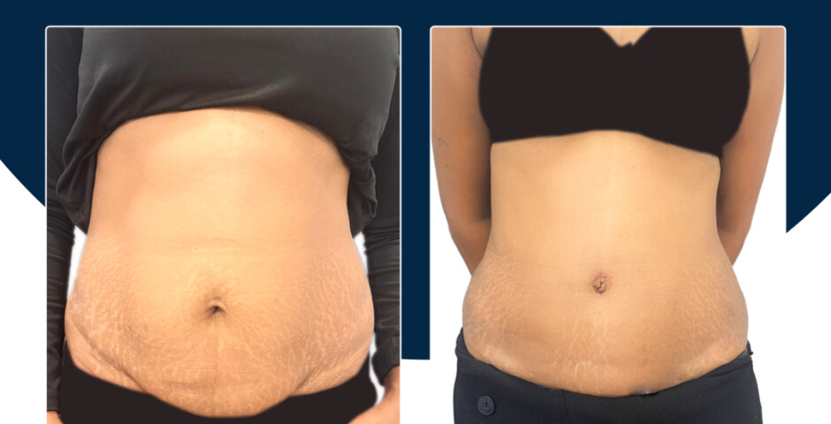 Face Plastic Surgery Cost in India and Transparent Pricing at Personiks